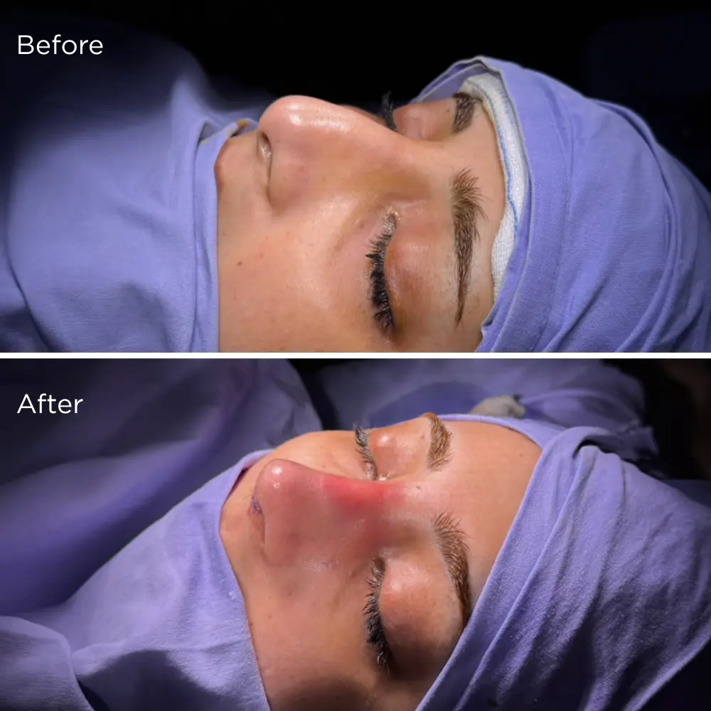 Before and after rhinoplasty surgery showing nose reshaping results